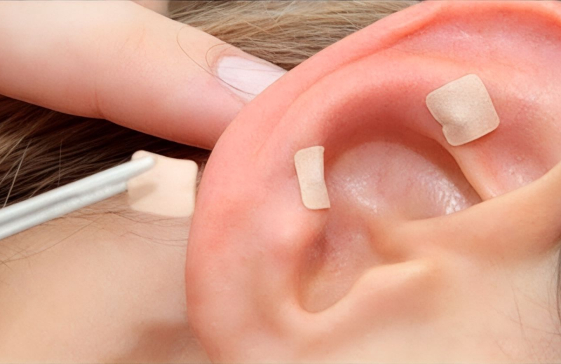 Auriculoterapia